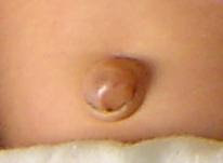 Hernia umbilical