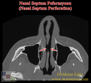 Repair of nasal septum perforation with rib cartilage - Repairing of septum peforation - Closure of nasal septum perforation with rib cartilage - Nasal septum perforation rapairing surgery - Treatment of large septal perforation - Nasal septum perforation repair in Istanbul