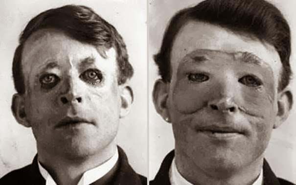 Уолтер Ео, один из первых кто подвергнулся продвинутой пластической хирургии и пересадке кожи, 1917 г.