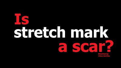 Is stretch mark a scar? | Healthbiztips