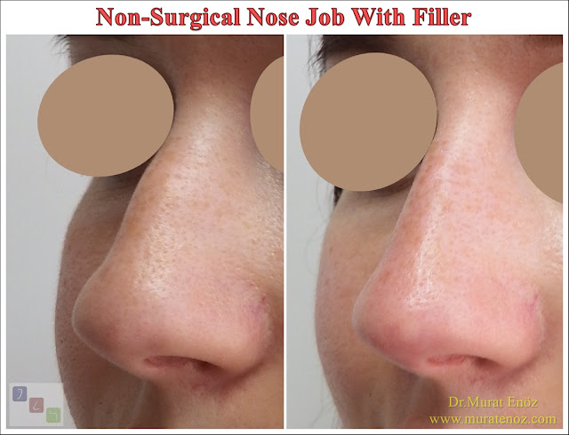 Non-surgical nose job - Non surgical nose job with filler in İstanbul - Non-surgical rhinoplasty in İstanbul - Nose tip filler augmentation in İstanbul - Non-surgical rhinoplasty in İstanbul - Nose filler injection in Turkey - The 5 Minute Nose Job in İstanbul, Turkey - Non-surgical nose job in Istanbul - Non-surgical nose job istanbul - Nose filler injection Turkey - Injectable nose job - Liquid rhinoplasty