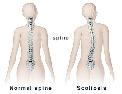 Trật xương sống lưng và hướng điều trị