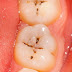 Nguyên nhân gây sâu răng phổ biến nhất hiện nay?