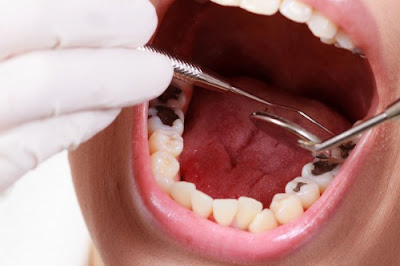 Kỹ thuật nhổ răng bị nhiễm trùng an toàn