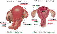 penyakit kista ovarium