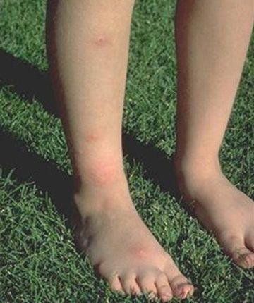 How to Treat Flea Bites on Children