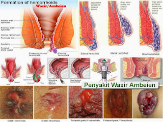 Obat ampuh menghilangkan benjolan wasir yang sudah parah