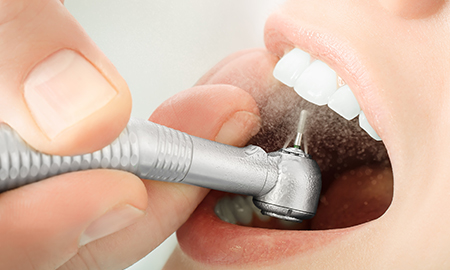 dental composite resin fillings