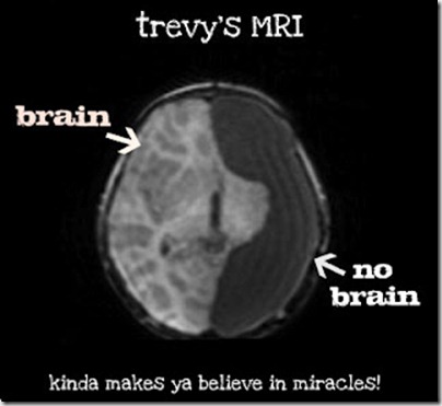 trevys MRI 