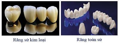 Tìm hiểu một số loại răng sứ thẩm mỹ đẹp