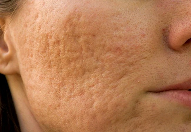 3 great ways to get rid of Acne Scars 
