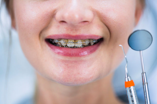 Berapa Lamakah Waktu dan Proses Pemasangan Kawat Gigi?