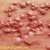 Cách phát hiện bệnh herpes sinh dục