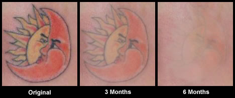 Removal Tattoos on Skin And Dental Care Blog  Is Tattoo Removal Procedure Safe