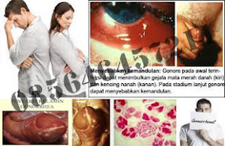 Pengobatan Gonorrhea (Kelamin Keluar Nanah) Wanita