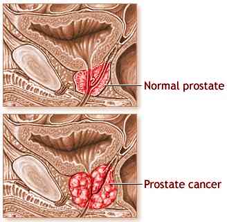 Images Prostate Cancer
