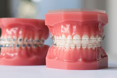 Niềng răng mắc cài kim loại tự buộc là gì? 