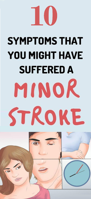 10 Symptoms That You Might Have Suffered A Minor Stroke