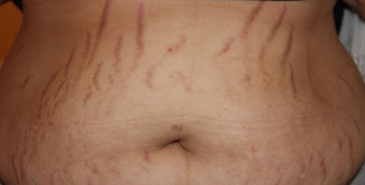 Cara Menghilangkan Stretch Mark Secara Alami