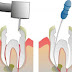 Keep Your Breath Assured with an Effective Root Canal Treatment  