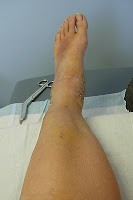 Click for Larger Image of Foot Without Cast