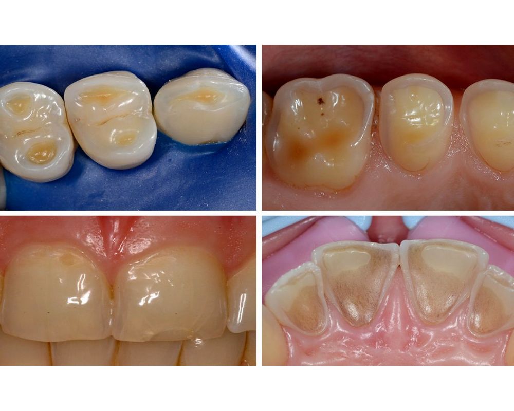 Erosive Tooth Wear