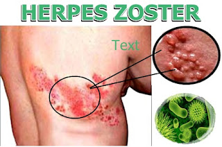 Cara Pengobatan herbal penyakit kelamin herpes