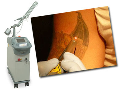 Laser Tattoo Removal