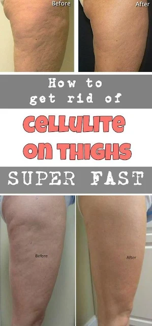 Natural Tips and Treatments for Cellulite