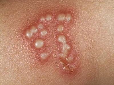 cara menyembuhkan herpes