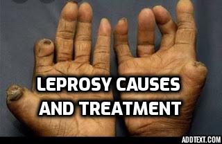 Leprosy causes and treatment