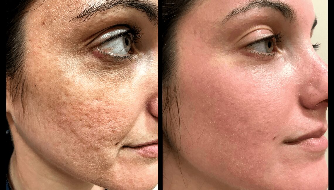 Halo Skin Resurfacing