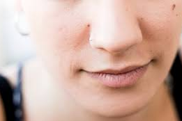 Blackheads On Chin: 20+ Top How To Get Rid with Fast at Home