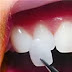 Kosmetische Zahnmedizin Veneers und über