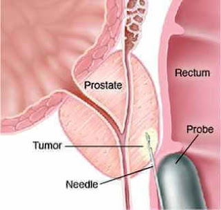 Prostat biyopsisi