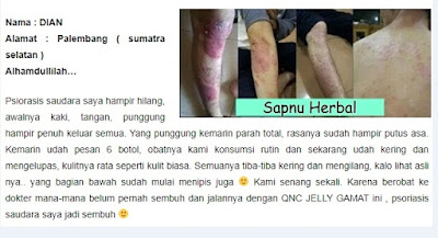 Cara Menghilangkan Milia Pada Kulit Bayi Dan Anak-Anak