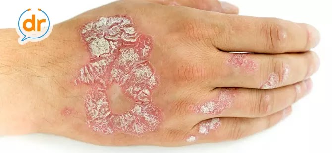 Obat Herbal Eksim Dermatitis