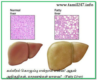 கல்லீரல் கொழுப்பு, கல்லீரல் நோய்கள், அறிகுறிகள், வீக்கம் குறைய, கல்லீரல் கொழுப்பு குறைய, kalleeral noi, kalleeral veekam in tamil, kalleeral function, kalleral veekam, Fatty liver symptoms in tamil, enlarged fatty liver