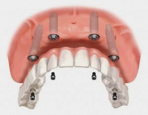 Douleur implant dentaire