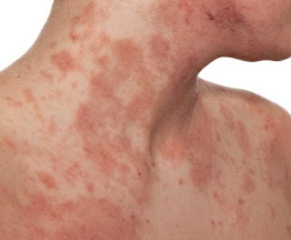 how to treat eczema