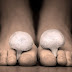 8 Natural Home Remedies For Athlete’s Foot