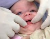 Bebeklerde diş çıkartma ve ilk diş