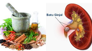 CARA PENGOBATAN GEJALA PENYAKIT BATU GINJAL