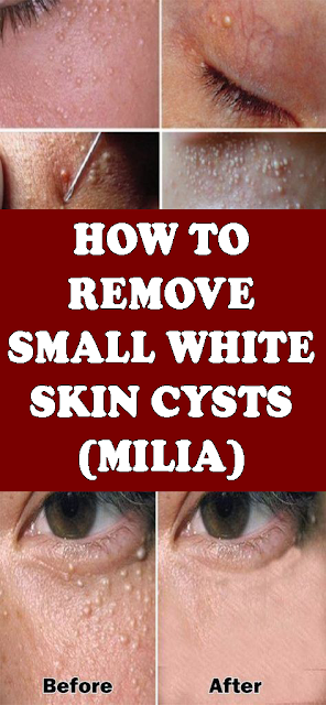 MILIA: How To Remove The Small White Skin Cysts?