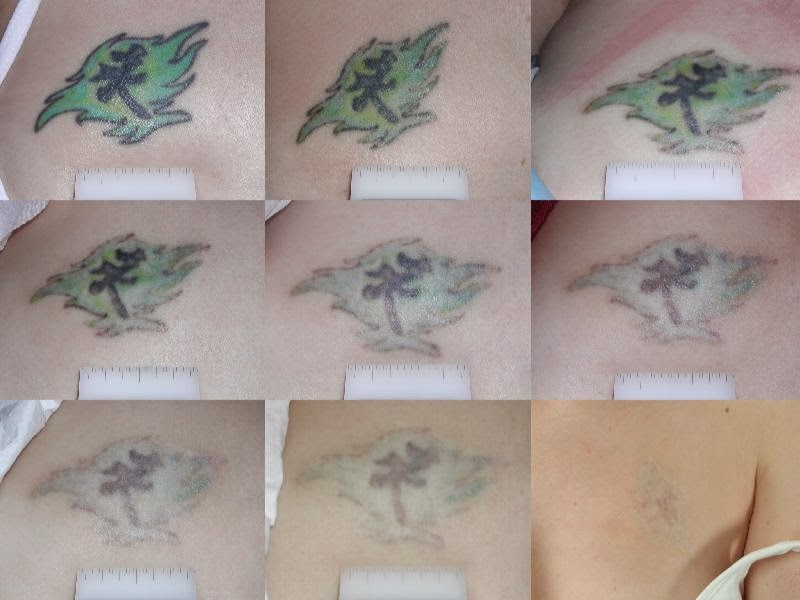 How To Remove A Tattoo