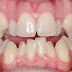 Thông tin về phương pháp niềng răng nhanh