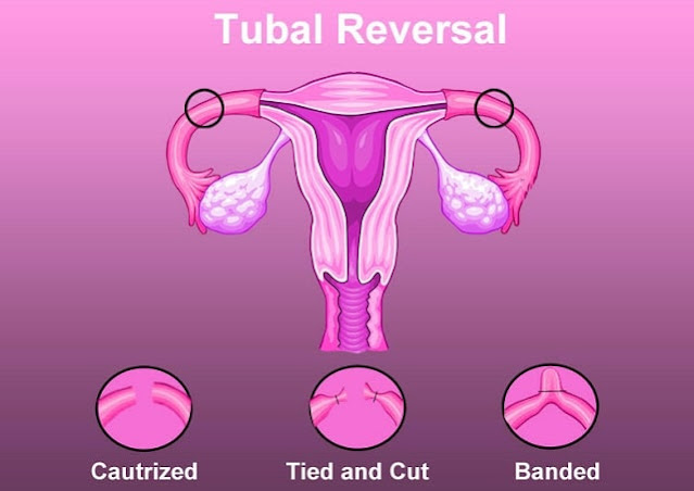 benefits of tubal reversal surgery fallopian tubes fertility