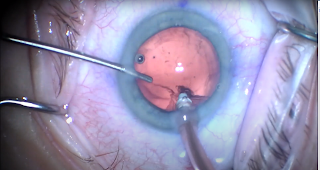 Cataract Surgery