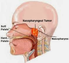 Kanker Nasofaring, Kanker Pada Hidung dan Tenggoroan