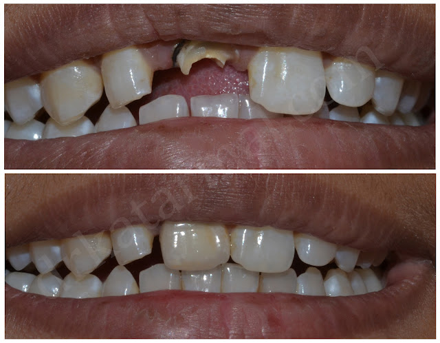 Fractured Front tooth restored with  Dental Crown